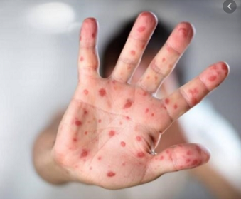 Biểu hiện của bệnh Tay chân miệng